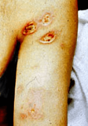 Arco de eletricidade queima arqueando pelo ar e entrando no corpo de um homem nas axilas