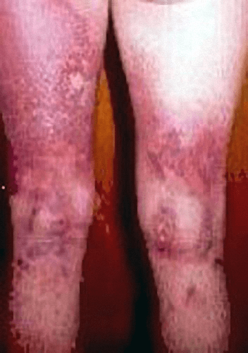O contato térmico onde a corrente elétrica saiu do corpo queima as pernas de um homem