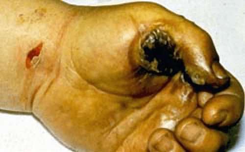 Ferida de entrada e queimaduras térmicas na mão de um trabalhador causadas por choque elétrico de uma ferramenta superaquecida que ele estava usando