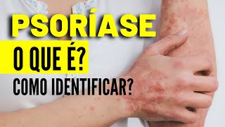 A psoríase se manifesta através de lesões avermelhadas e escamosas na pele, que podem surgir em qualquer parte do corpo