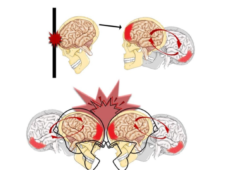 Causas da Concussão Cerebral